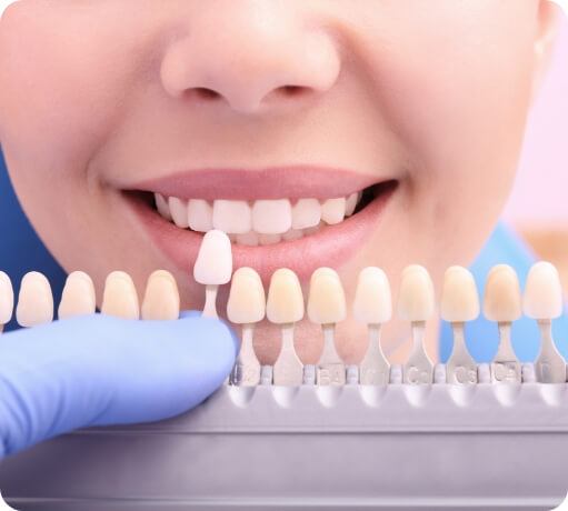Smile compared to tooth colored filling options