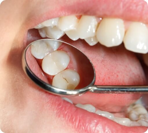 Closeup of teeth with dental sealants