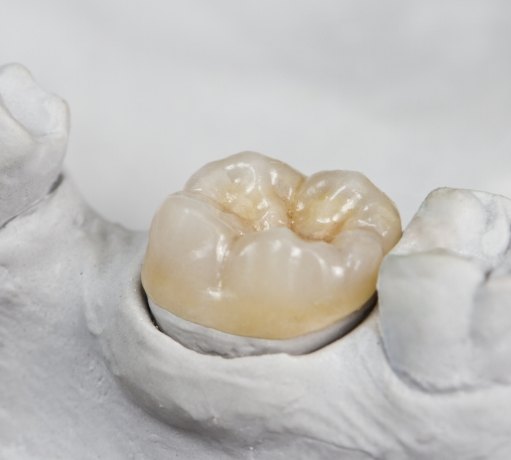 Model smile with dental crown restoration