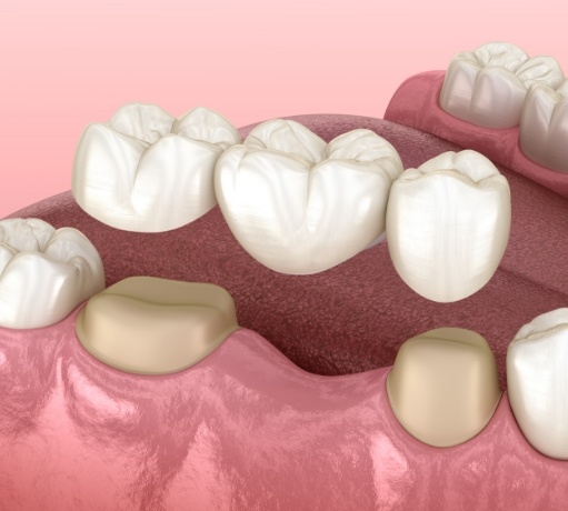 Animated smile during dental bridge placement