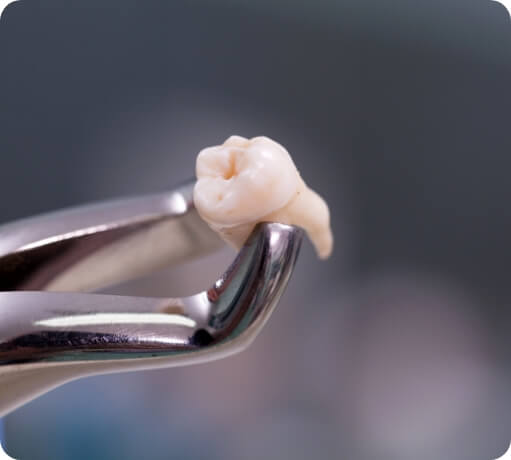 Metal clasp holding extracted tooth