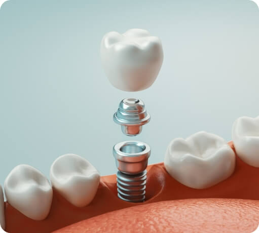 Animated smile demonstrating the four step dental implant process