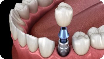 Animated smile during dental implant supported dental crown placement