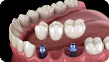 Animated smile during dental implant supported fixed bridge placement