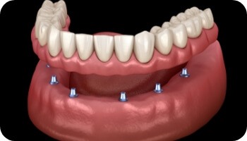 Animated smile during dental implant supported denture placement