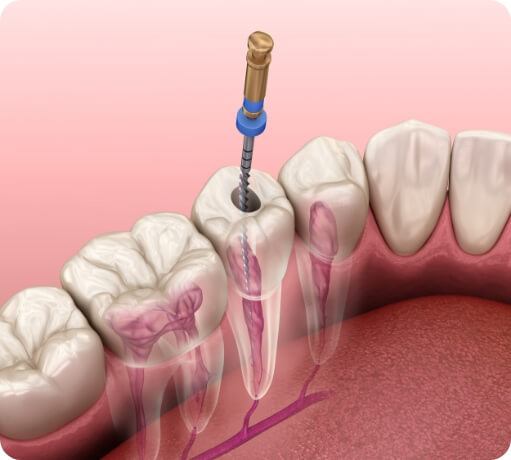 Animated smile during root canal treatment process