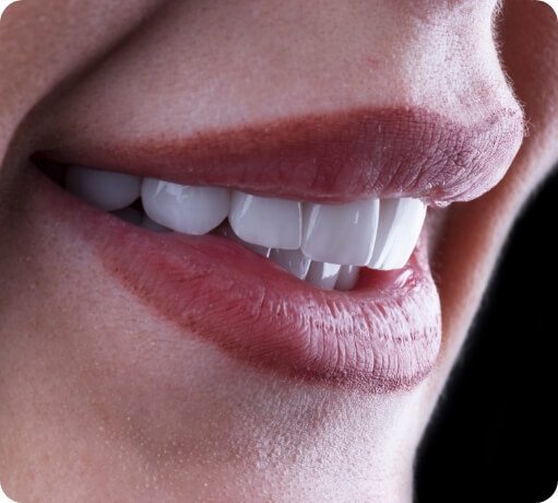 Closeup of flawless smile with veneers